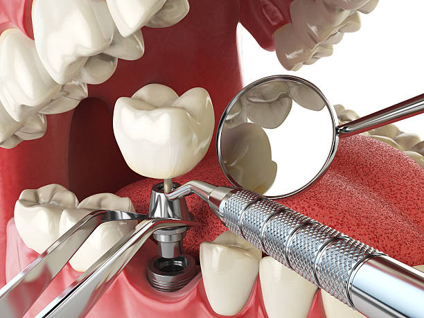 Best Emergency Tooth Extraction in Urbana, IA